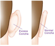 Protruding-ears-hypertrophy-concha